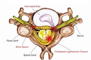 Discectomy-and-Fusion