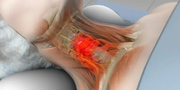 Discectomy and Fusion (ACDF)