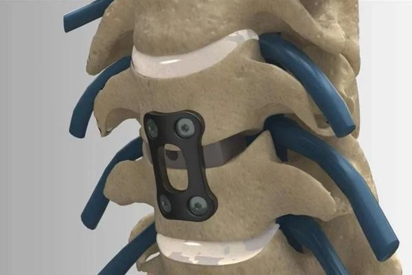 Discectomy and Fusion (ACDF)