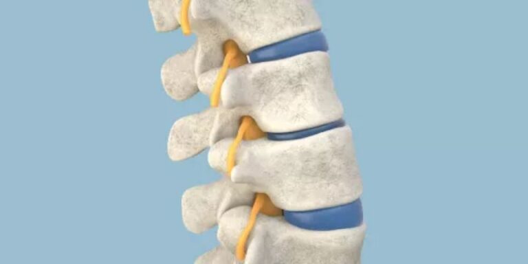 Lumbar Degenerative disc(DDD)