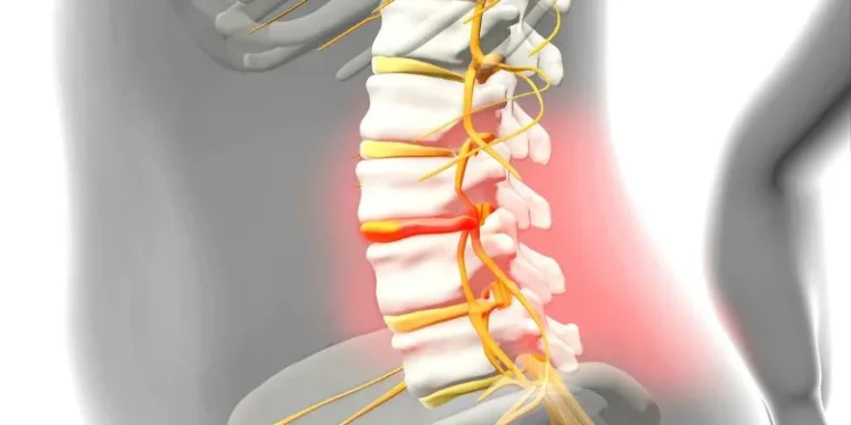 Slipped-Herniated Disc